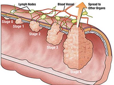 Polyps มีผลต่อมะเร็งลำไส้อย่างไร?