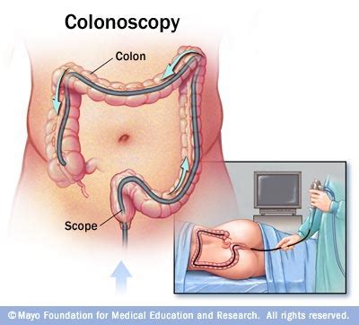 Polyps มีผลต่อมะเร็งลำไส้อย่างไร?